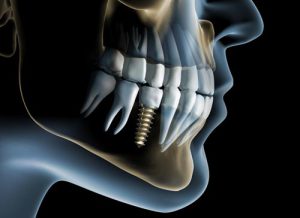 Dentist Mississauga Dental Implants