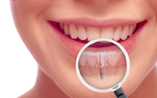 Dentistry Mississauga Dental Implants