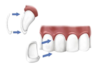 Family Cosmetic Dentistry Mississauga Veneers