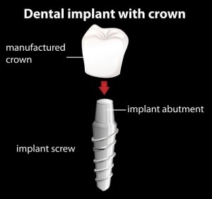 Mississauga Dental Implants