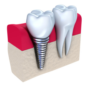 Mississauga Dental Implants