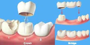 Mississauga Family Dentist Dental Crowns Bridges