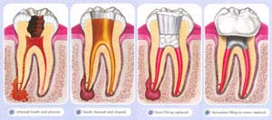 Mississauga Family Dentist Implants Invisalign Endodontic Root Canals