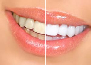 Teeth Whitening Mississauga Family Dentist Implants Invisalign Cosmetic Emergencies